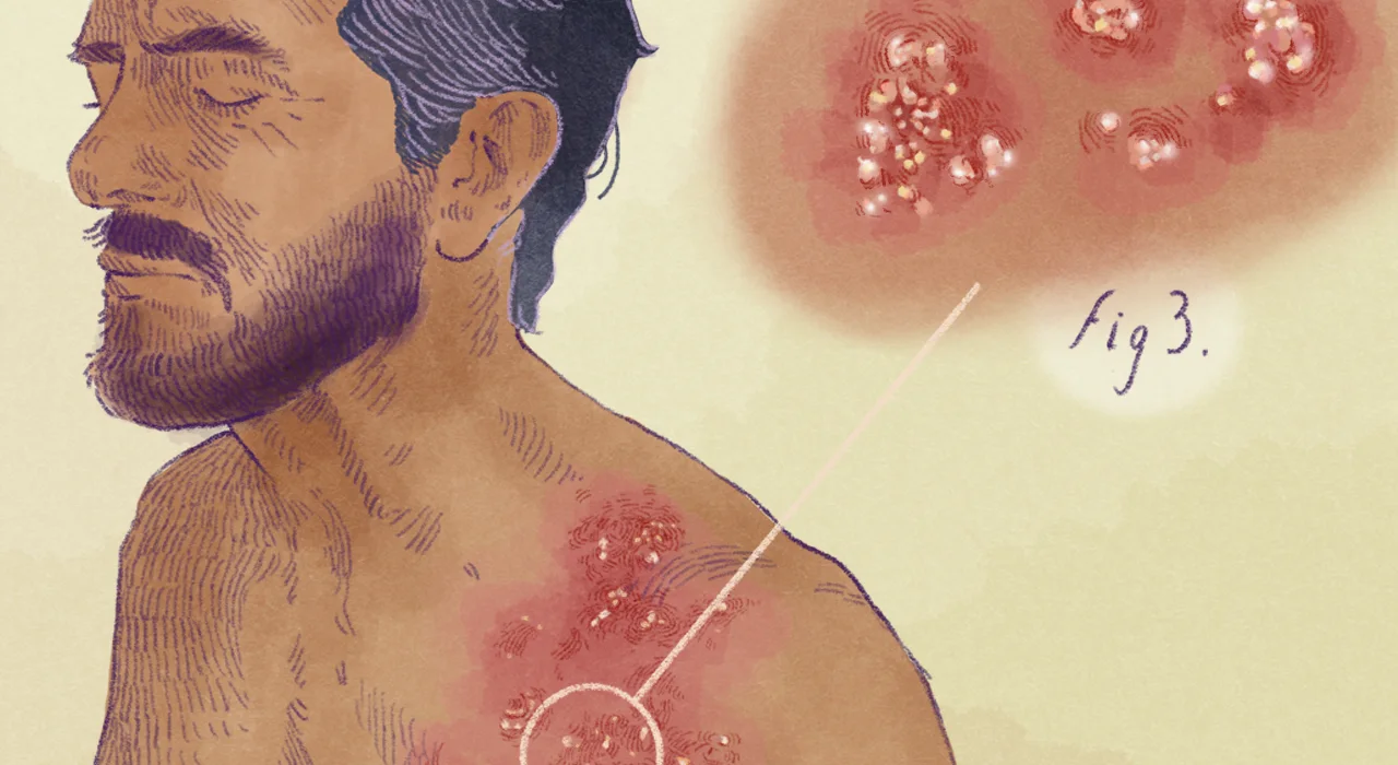 herpes zóster