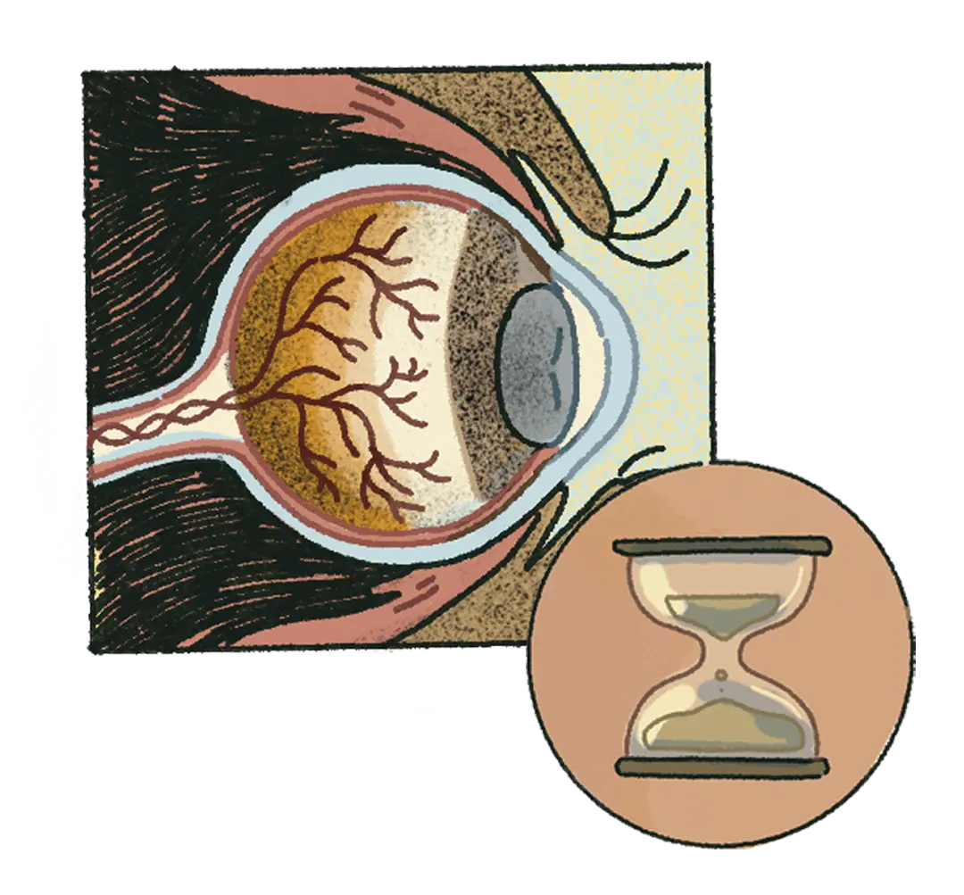 miopía y astigmatismo