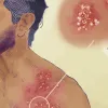 herpes zóster