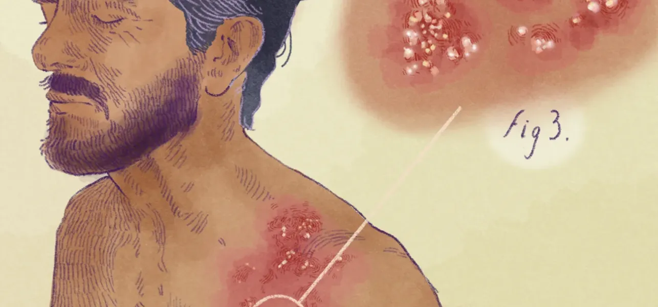 herpes zóster