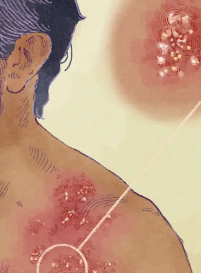 herpes zóster