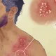 herpes zóster