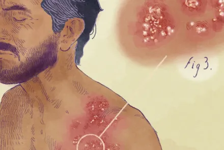 herpes zóster